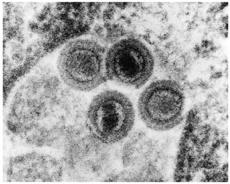 ヒトヘルペスウイルス6(HHV-6)